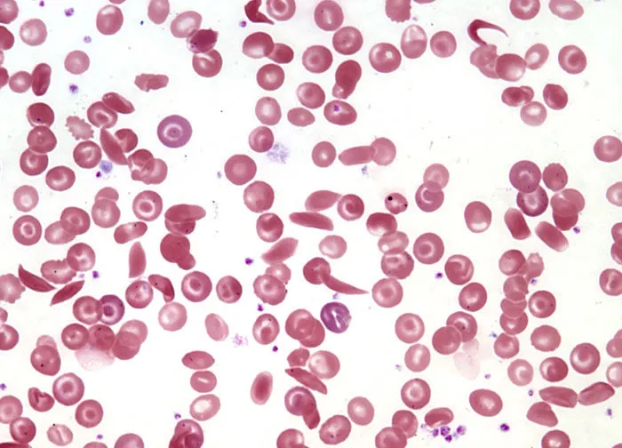sickle cell anemia